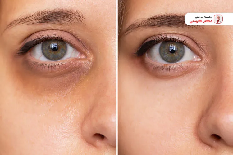 کمبود برخی ویتامین‌ها یا مصرف برخی دارو ها موجب کبودی صورت و بدن میشود.