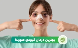 برای درمان کبودی صورت باید مجموعه ای از روش‌های غذایی و دارویی و..را درنظر بگیرید.