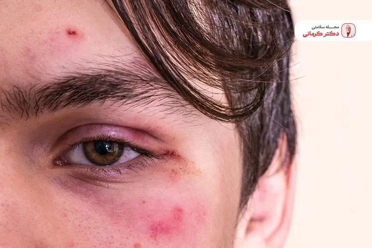 قبل از درمان کبودی صورت باید علت ان را به خوبی بررسی کنیم.