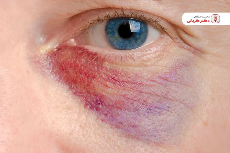 افزایش سن نیز ممکن است موجب کبودی صورت یا بدن شود.