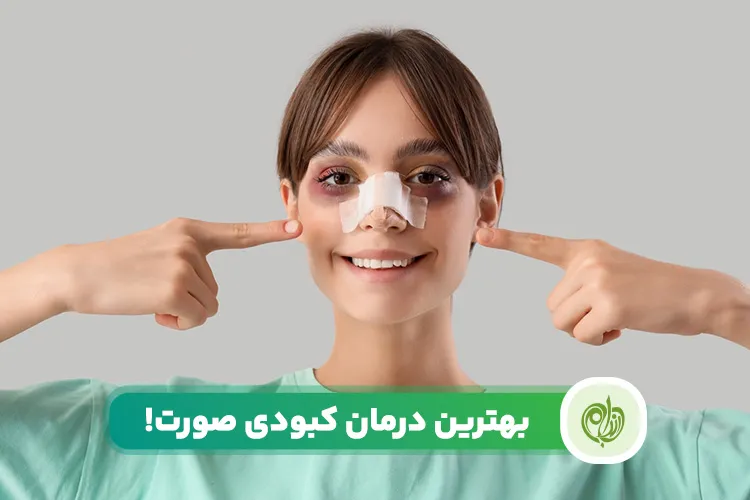 مقاله برای درمان کبودی صورت باید مجموعه ای از روش‌های غذایی و دارویی و..را درنظر بگیرید.