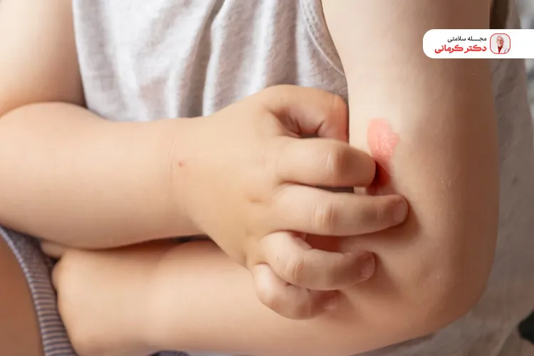 درباره مصرف میوه های حساسیت زا در کودکان مراقبت باشید!