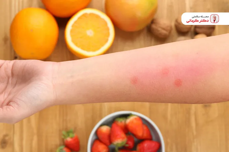 مصرف برخی میوه های آلرژی زا می‌تواند مانع مشکلات سلامتی شود.