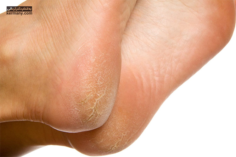 یکی از دلایل ترک کف پا بیماری‌های قارچی و تمیز نبودن کف پا است.
