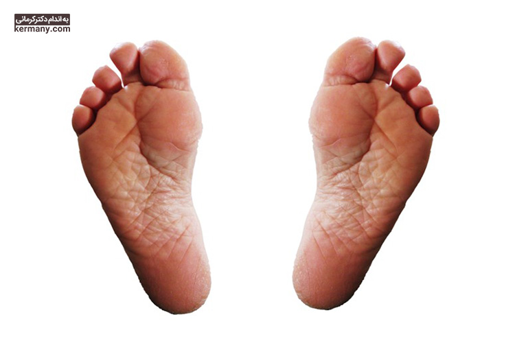 جوش شیرین، عسل و موز از جمله مواد طبیعی است که برای درمان ترک و خشکی کف پا توصیه می‌شود.