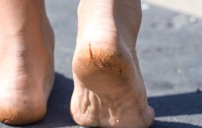 چرا پاهایتان همیشه خشک، پوسته پوسته و ترک خورده است؟