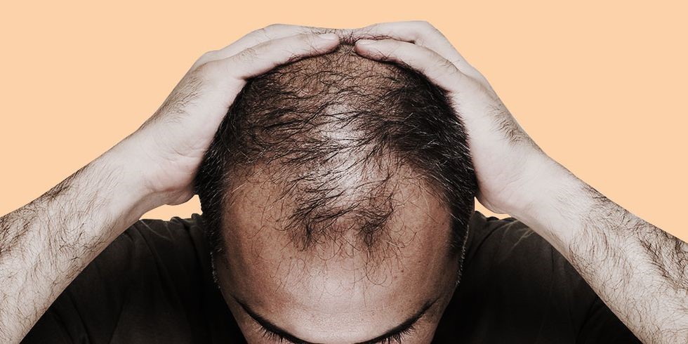 ریزش مو در مردان ؛ دلایل و درمان ریزش مو - 52 - ریزش مو در مردان - ورزش و سلامتی