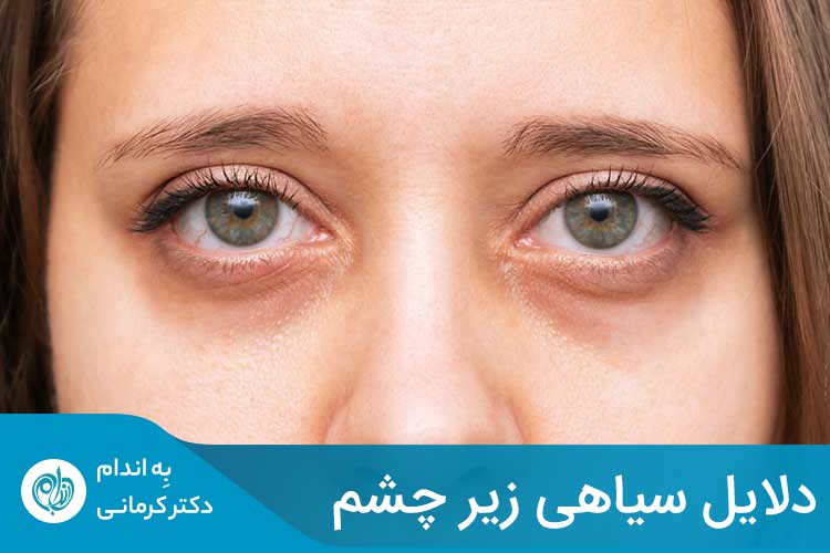 خستگی مفرط و کمبود خواب، می‌تواند یکی از علل ایجاد حلقه‌های سیاه زیر چشم شود.