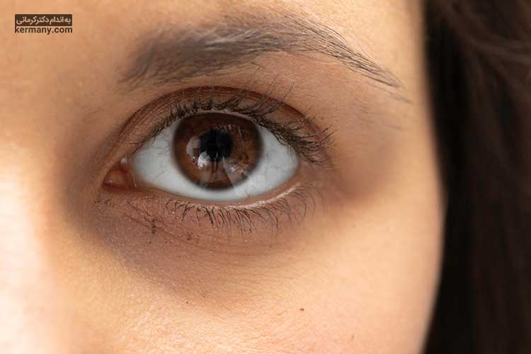 سیاهی زیر چشم در کنار علائم زیر می‌تواند یک علامت هشدار اولیه برای آسم باشد