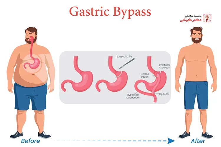 ایجاد مشکلاتی در محل جوش خوردن معده و روده از عوارض عمل بای پس معده است.