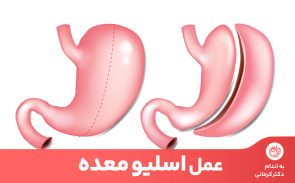 عمل اسلیو معده، نوعی روش لاغری است که در آن بخش زیادی از معده برداشته می‌شود.