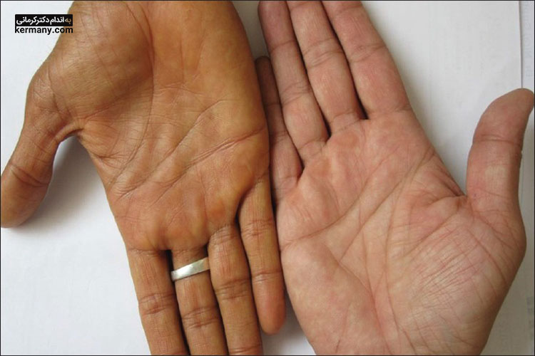 از عوارض جانبی رژیم هویج می‌توان به تغییر رنگ پوست به دلیل بتاکاروتن بالای بدن اشاره کرد.