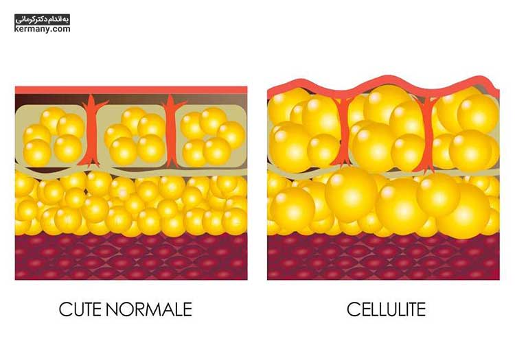 سلولیت چربی با سلولیت عفونی ناشی از نفوذ باکتری به زیر پوست متفاوت است.