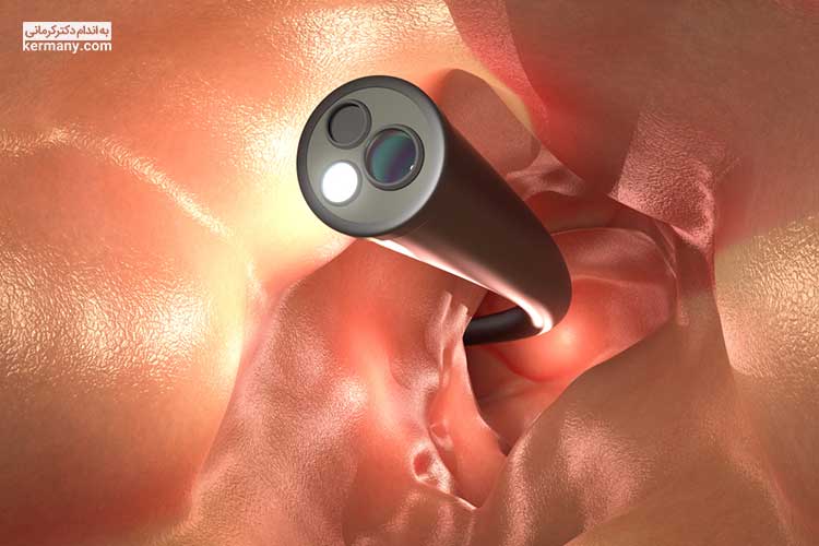پزشک شما ممکن است آندوسکوپی را برای مشاهده دقیق داخل روده بزرگ با استفاده از یک دوربین کوچک نصب شده در انتهای یک لوله روشن توصیه کند.