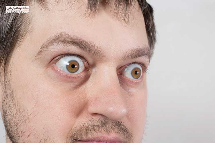 افرادی که به بیماری گریوز مبتلا هستند، چشمان بزرگی دارند که از حدقه چشم بیرون‌زده است.