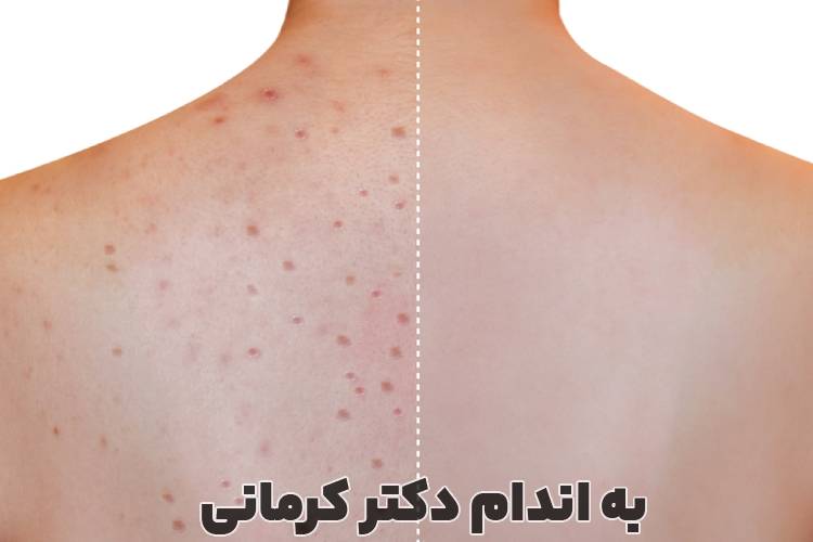 درمان جوش کمر
