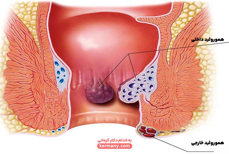 ترومبکتومی هموروئید خارجی