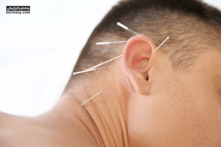 طب سوزنی طحال و نقطه شن‌من در گوش در متعادل‌کردن سطح هورمون موثر هستند.