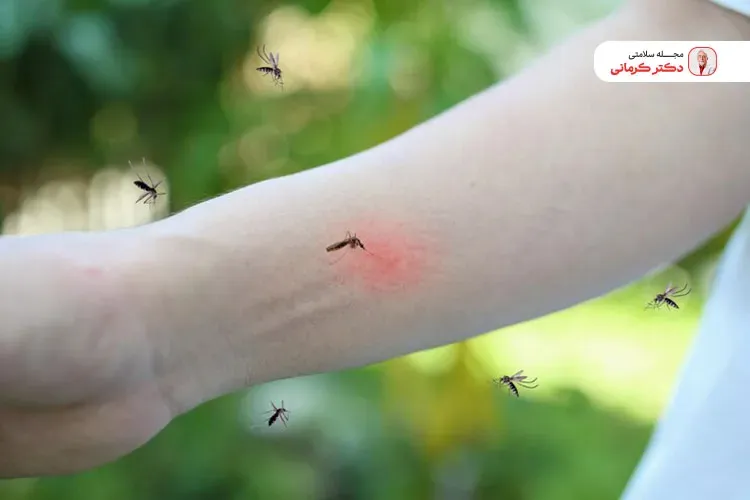 برای درمان نیش پشه می‌توان از چند ماده غذایی ساده استفاده کرد.