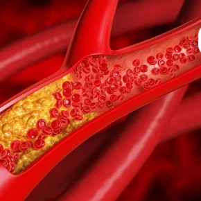مقاله روش های درمان چربی خون