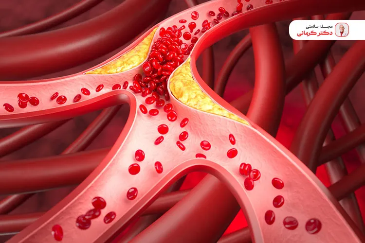 چربی خون بالا یعنی میزان چربی داخل رگ‌ها افزایش یافته و ممکن است آن را مسدود کند.