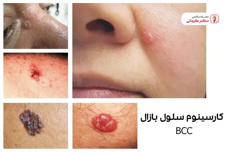  کارسینوم سلول پایه یا بازال