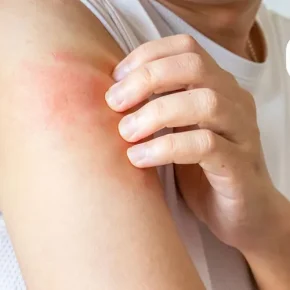 مقاله برای درمان خشکی پوست چه بخوریم؟