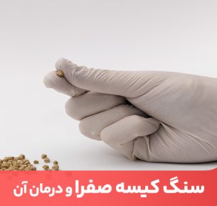 یکی از علل سنگ صفرا اضافه وزن و چاقی شکمی است.