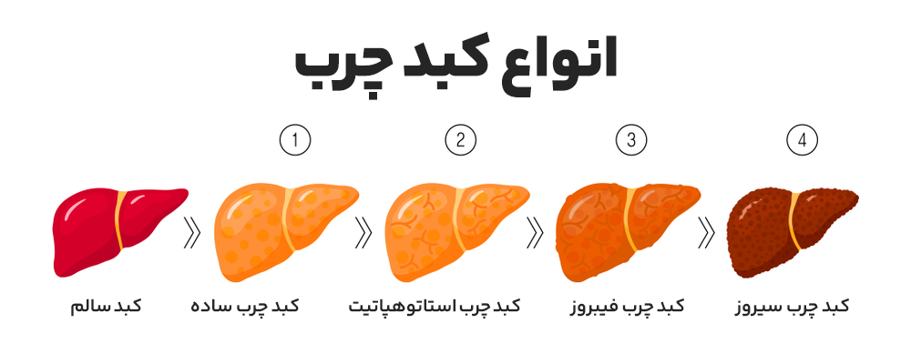 علائم کبد چرب در هر مرحله از بیماری چگونه است؟ - 1 - علائم کبد چرب - بیماری ها