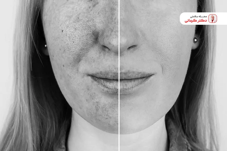 پیری زودرس پوست از عوارض اشعه فرابنفش خورشید است!