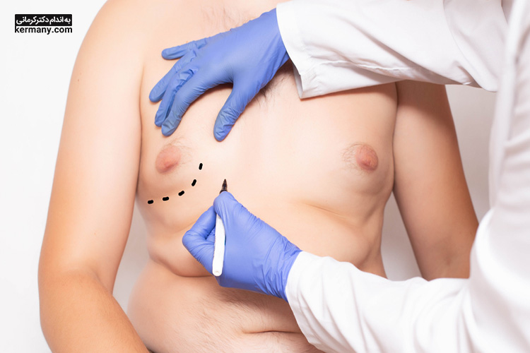 جراحی سینه یکی از آخرین درمان‌ها برای چربی سینه است.