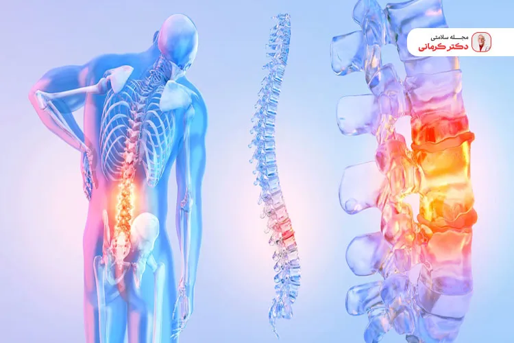 گودی کمر حتی میتواند بر اندام های داخلی بدن نیز تاثیرات منفی بگذارد.