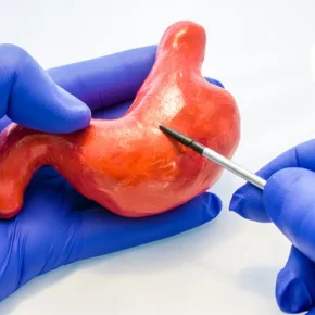 مقاله رژیم غذایی مناسب بعد از عمل اسلیو معده