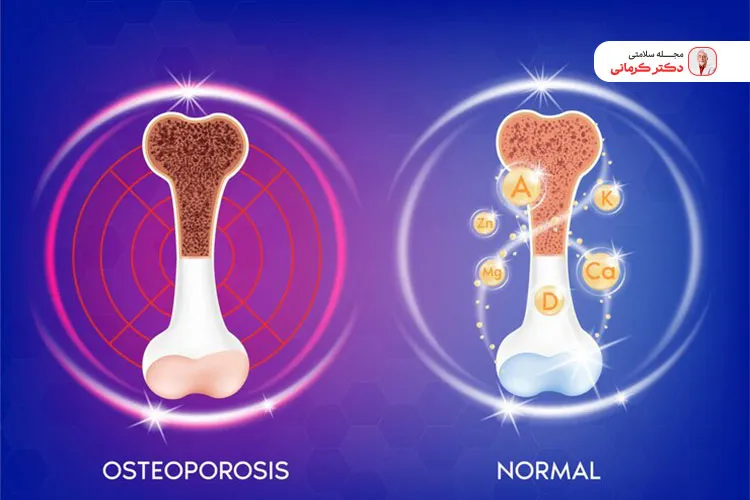 پوکی و ضعف استخوان ها یک علت گودی کمر است.