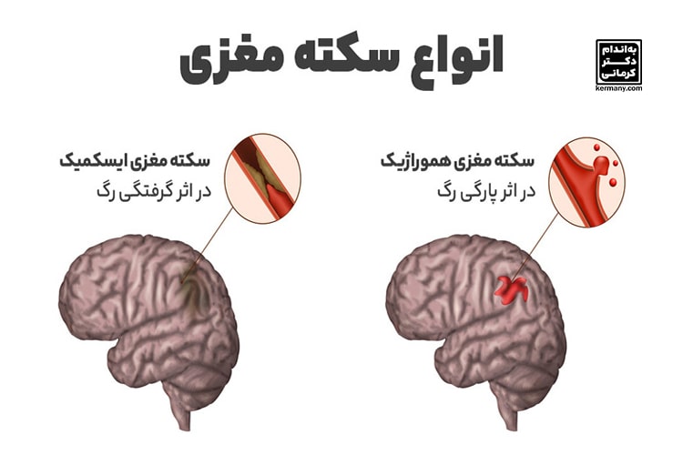 انواع سکته مغزی