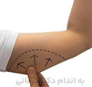 برای لاغری بازو باید از یک رژیم لاغری مناسب برای کاهش وزن کلی بدن خود کمک بگیرید.