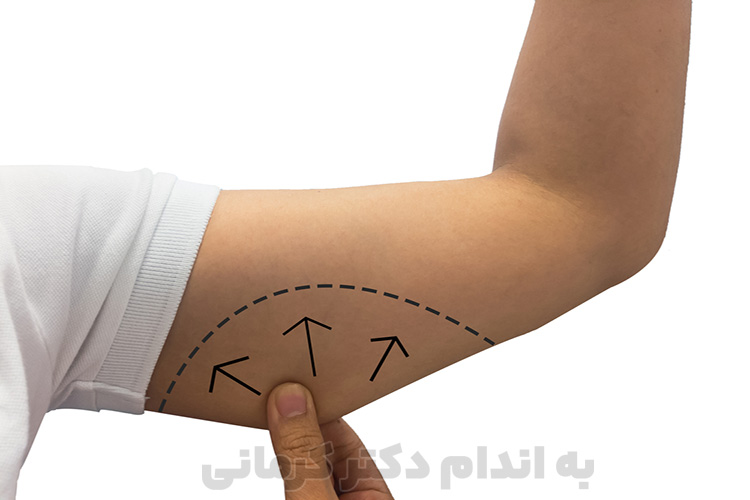 برای لاغری بازو باید از یک رژیم لاغری مناسب برای کاهش وزن کلی بدن خود کمک بگیرید.
