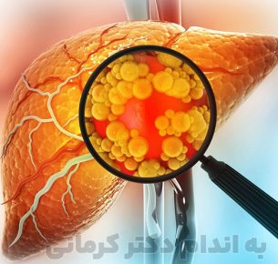 کبد چرب گرید 3 یعنی بیشتر از ۶۰ درصد آن چربی درگیر است.