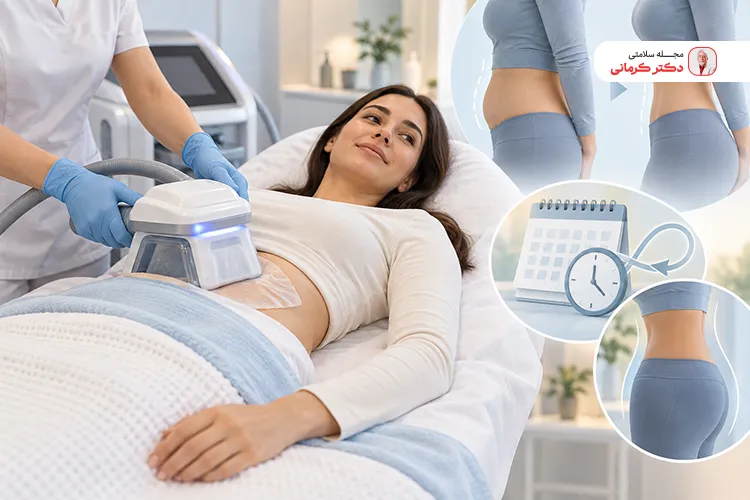 آیا نتایج کرایولیپولیز دائمی است؟