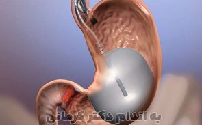 عمل بالن معده برای لاغری
