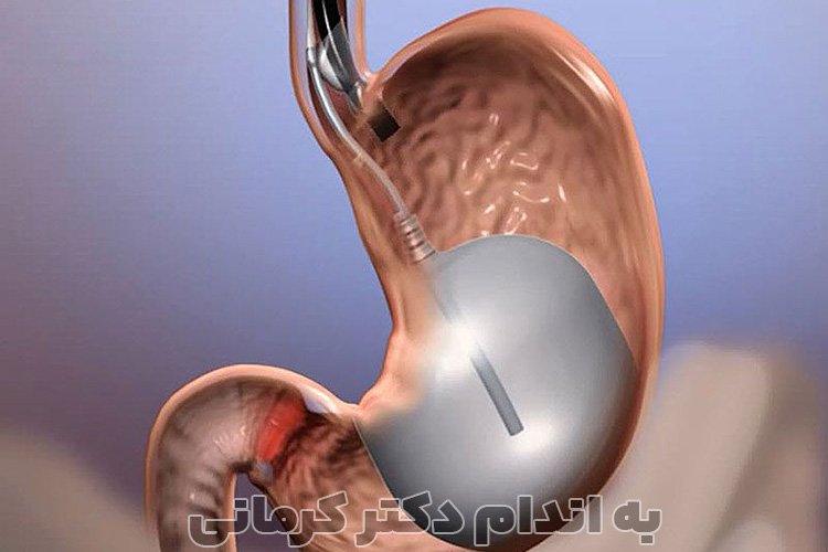 عمل بالن معده برای لاغری