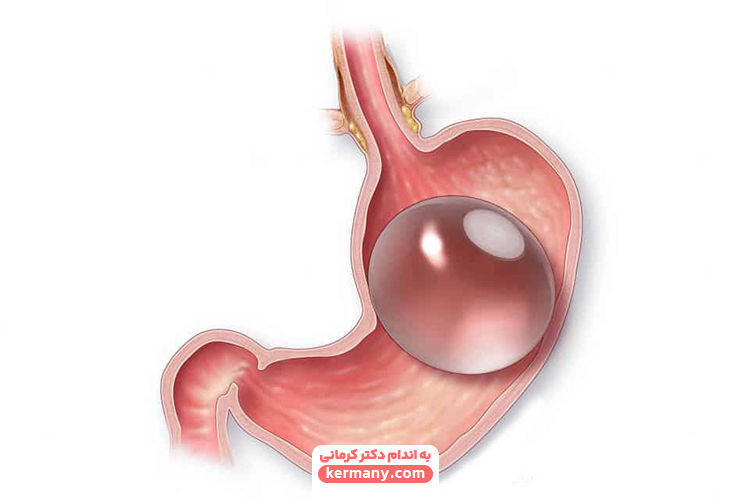 بالون معده چیست؟