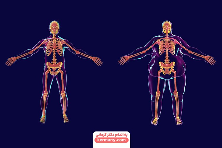 مشکلات آرتروز در اثر چاقی