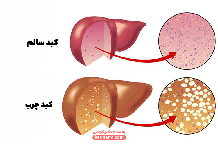 مکانیسم اثر قرص لیورگل برای کبد چرب