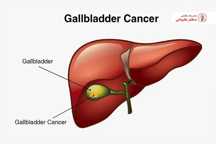سنگ کیسه صفرا اگر به موقع درمان نشود ممکن است منجر به سرطان کیسه صفرا شود.
