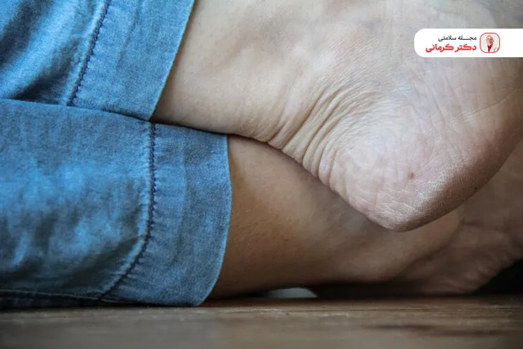 علائم کبد چرب در پا