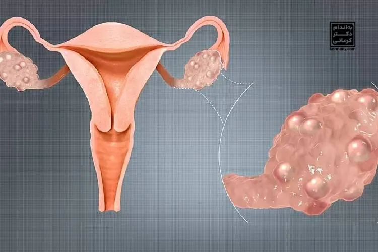 فواید رژیم کتو برای تخمدان پلی کیستیک