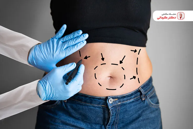  لیپولیز برای کاهش وزن سریع و همچنین فرم دهی بدن انجام می‌شود. 