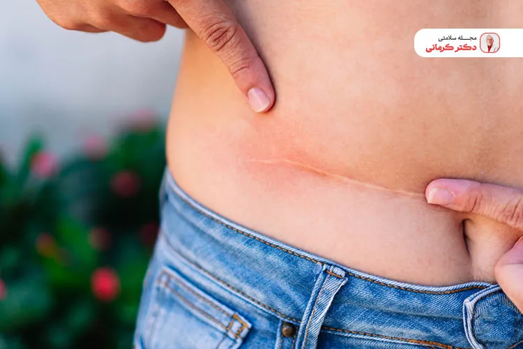 لیپولیز شکم اگر به درستی انجام نشود ممکن است منجر به عفونت و آسیب جدی شود.