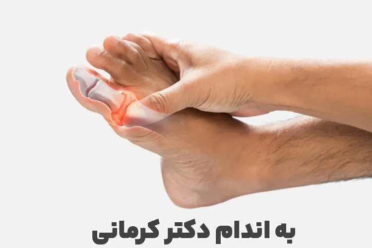 نقرس